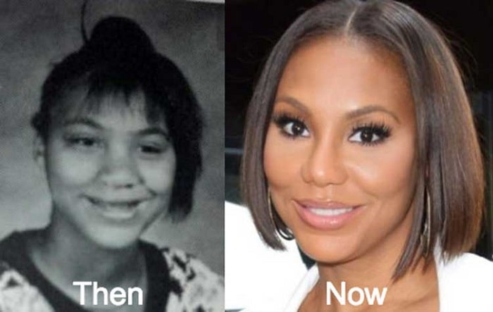 Tamar before and after her nose surgery.